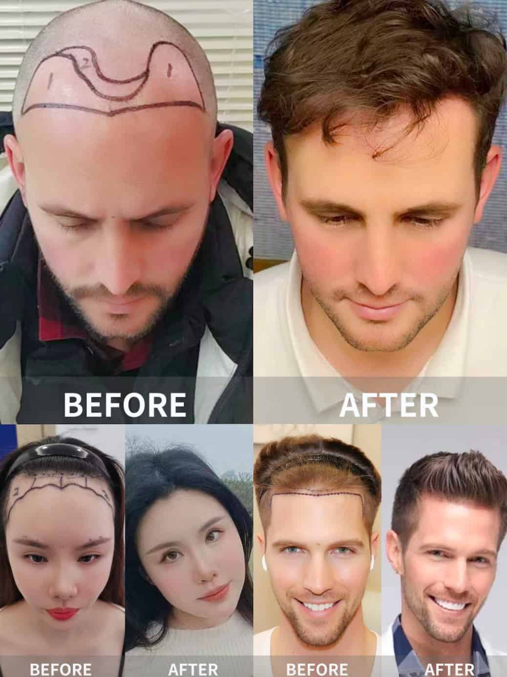 Microneedle Hair Transplant in China | Chengdu-Expat.com